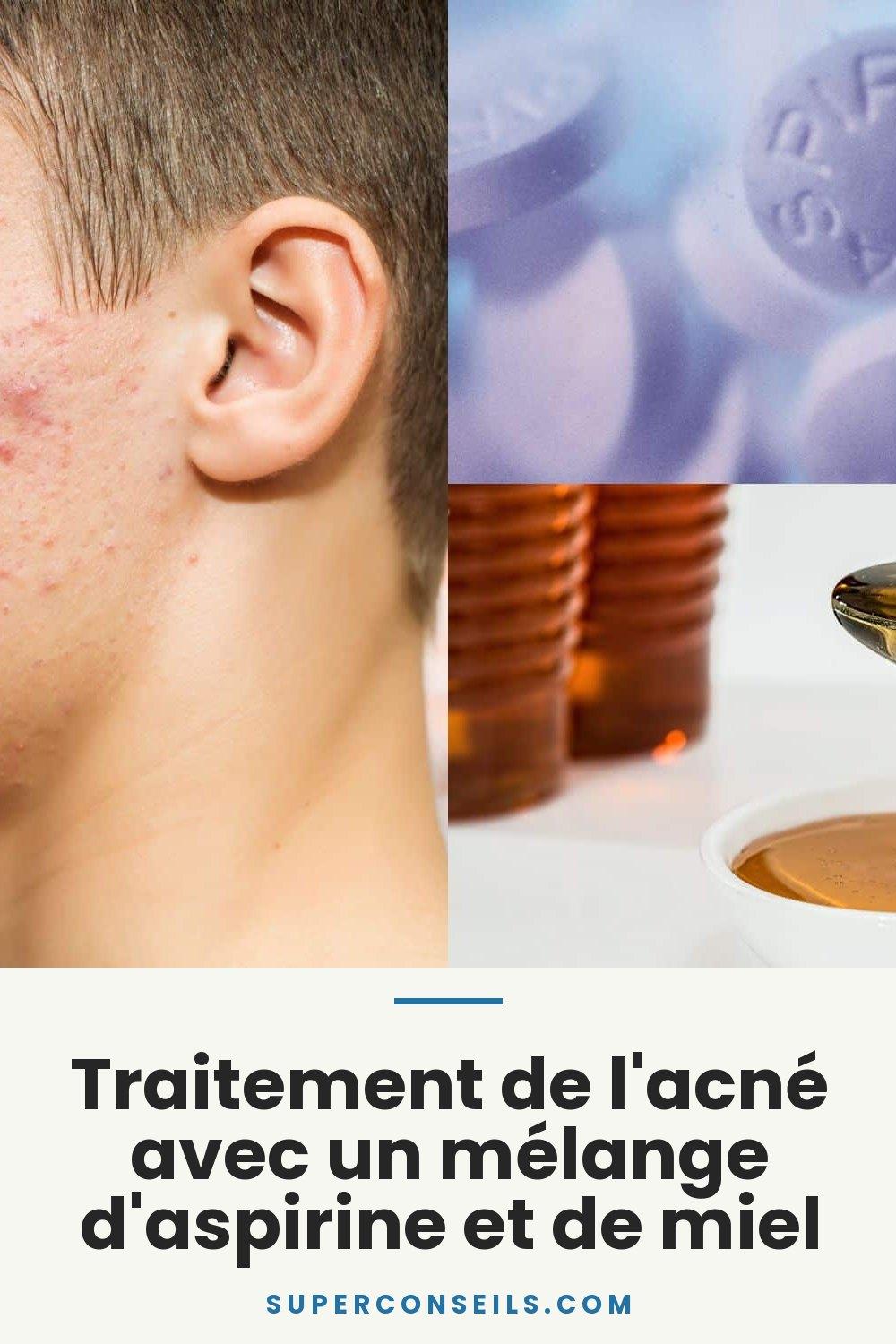 Traitement de l'acné avec un mélange d'aspirine et de miel